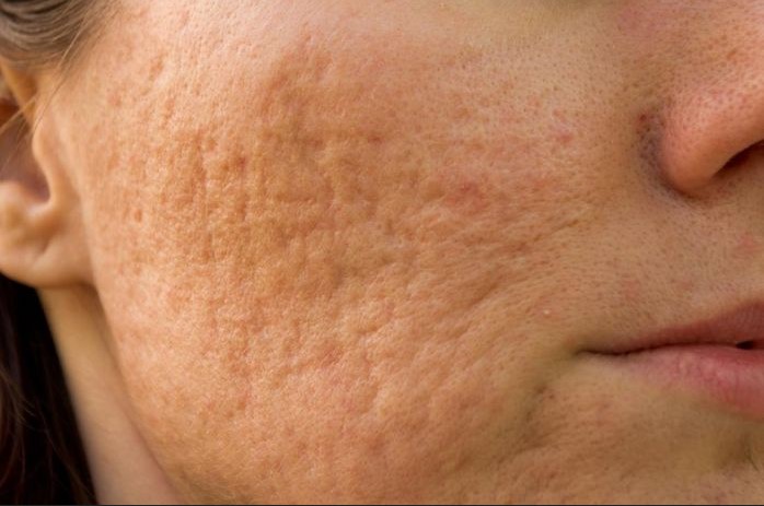 Contoh bekas jerawat atrophic scars berbentuk cekung