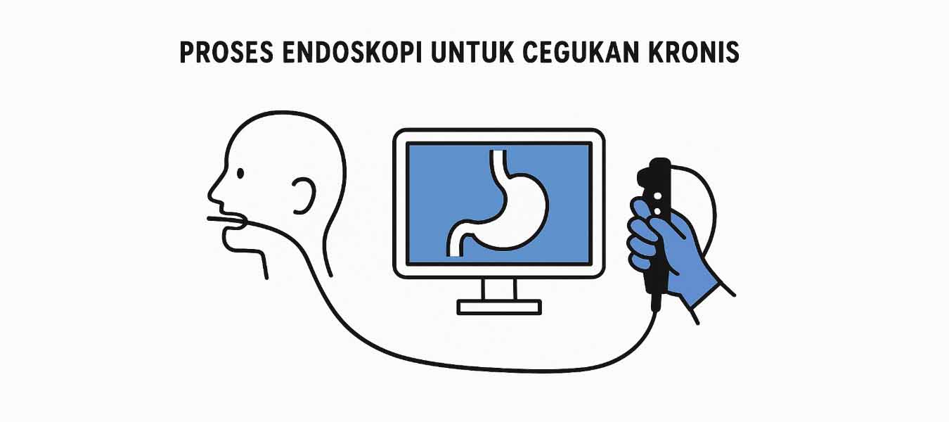 Proses endoskopi untuk cegukan kronis