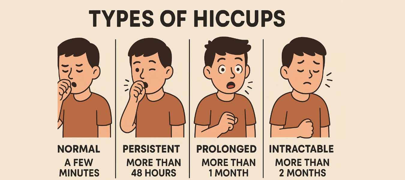 Jenis-jenis cegukan dan tingkat keparahannya